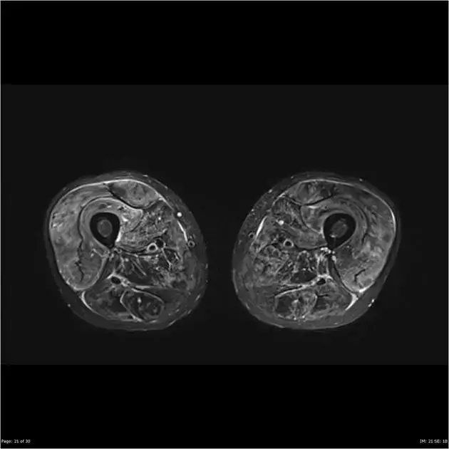 Miositi diagnosi e terapia a Palermo Dr. Roberto Bursi