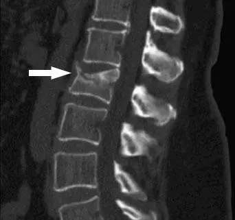 Diagnosi e cure per osteoporosi a Palermo - Dr. Roberto Bursi