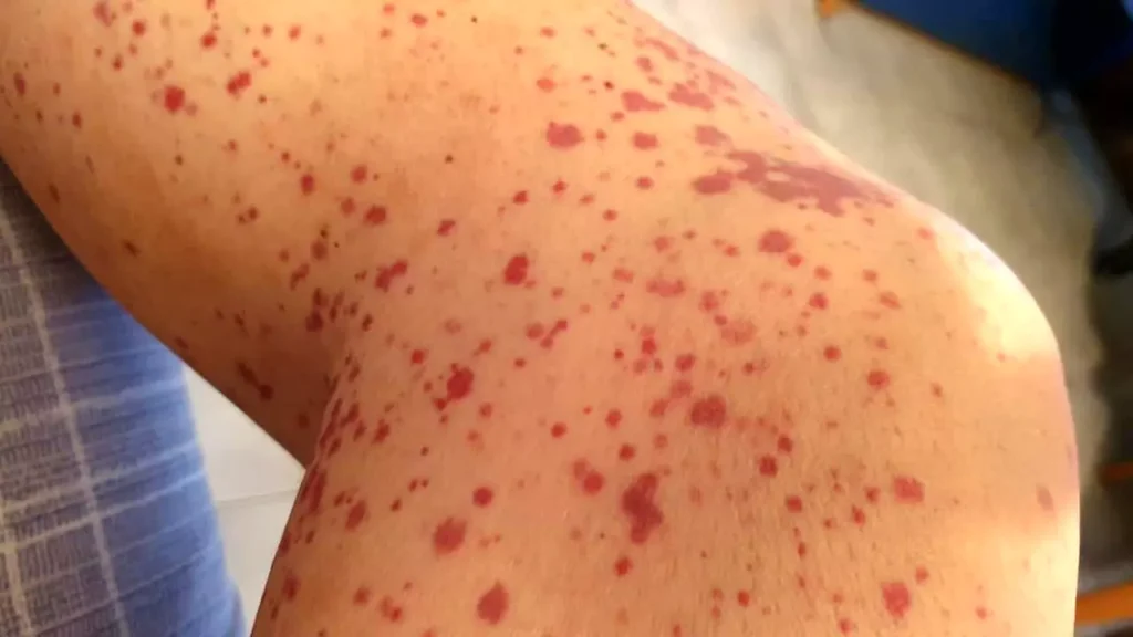 Cura delle vasculiti a Palermo: visita specialistica con il reumatologo Dr. Bursi Roberto