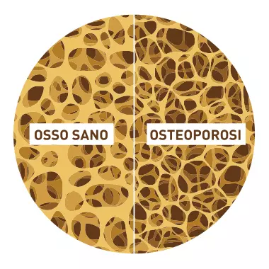 Osteoporosi a Palermo, diagnosi e cura